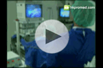 宮腔鏡手術視頻3