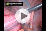 婦科腹腔鏡下子宮全切術手術視頻