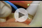 牙齦萎縮視頻手術視頻