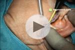 腮腺手術視頻