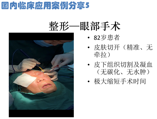 低溫射頻刀眼科整形手術應用